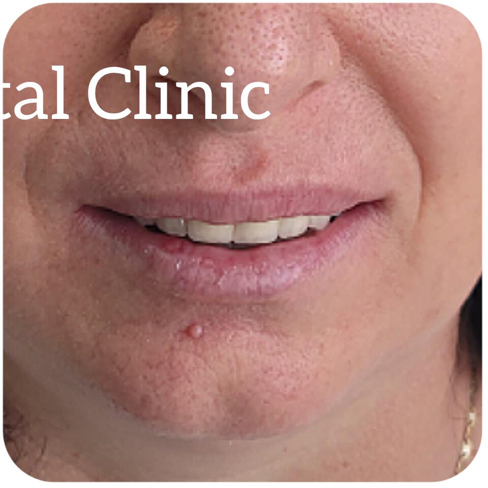 Dopo il Trattamento 5